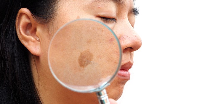 Doencas sazonais melasma